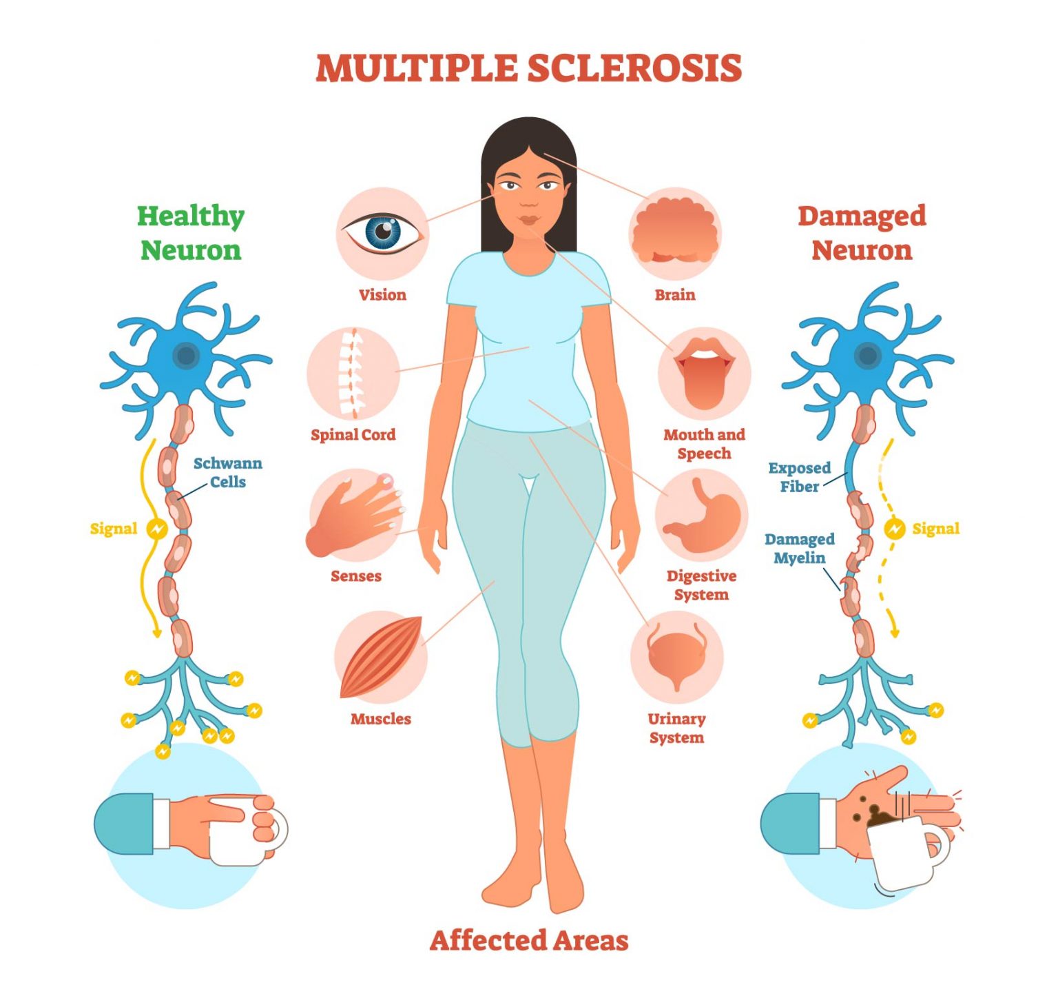 Multiple Sclerosis System Disorder Template