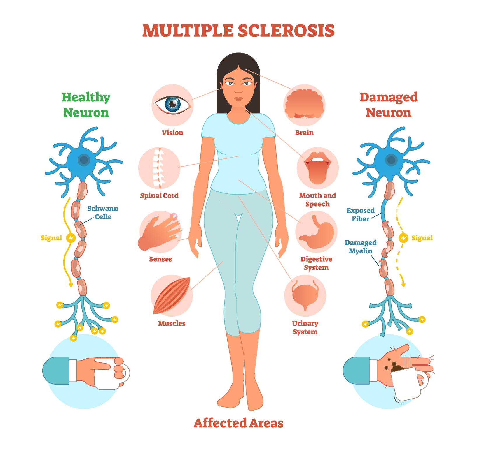 http://nursingipd.com/2020/08/28/multiple-sclerosis/