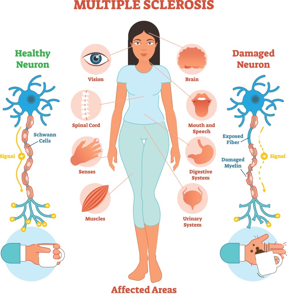 MS - Multiple Sclerosis