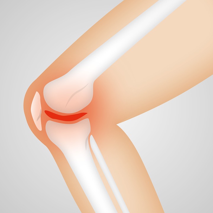 Arthrocalman osteoarthritis-knee