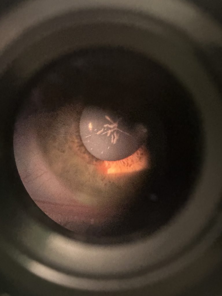 Snowflake Cataract. Image Credit Zena Maziak. Copyright 2026 All Rights Reserved.